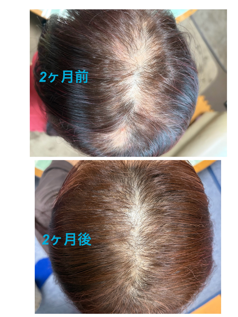 円形脱毛の症例 ビフォーアフター